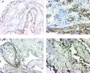 Fibromyalgia Type Four- Prostaglandin Dysregulation & Platelet Adhesion Associated Chronic Inflammation and Pain 3