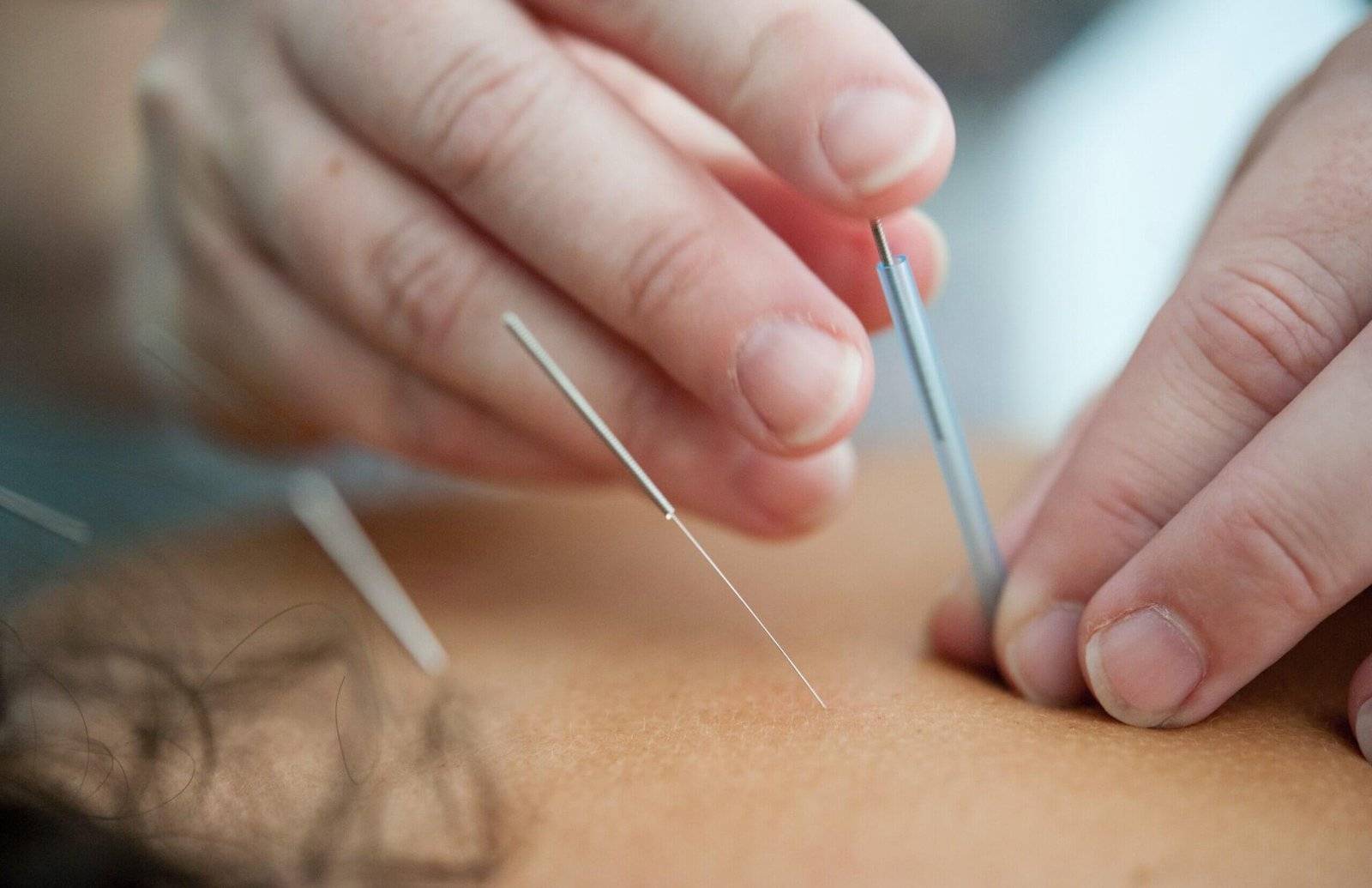 Acupuncture treatment for back pain , acute lower back pain, acupuncturist near me, best acupuncture in utah county 2 3 Acupuncture treatment for back pain , acute lower back pain, acupuncturist near me, best acupuncture in utah county 2 3