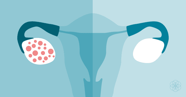 Polycystic ovary syndrome | Treatments for Infertility Resulting from PCOS 3