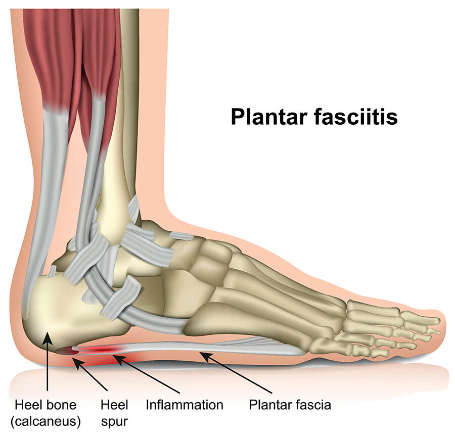 plantar fasciitis heel treatment